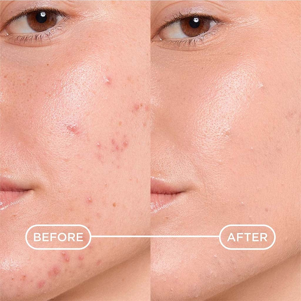 Bioderma Sébium Global Cover Universal Tint Acne Treatment